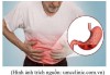 VIÊM DẠ DÀY – NGUYÊN NHÂN, TRIỆU CHỨNG, BIẾN CHỨNG VÀ CÁCH PHÒNG NGỪA