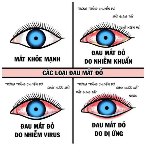 ĐAU MẮT ĐỎ BỆNH DỄ LÂY – NHẬN BIẾT SỚM ĐỂ PHÒNG NGỪA HIỆU QUẢ