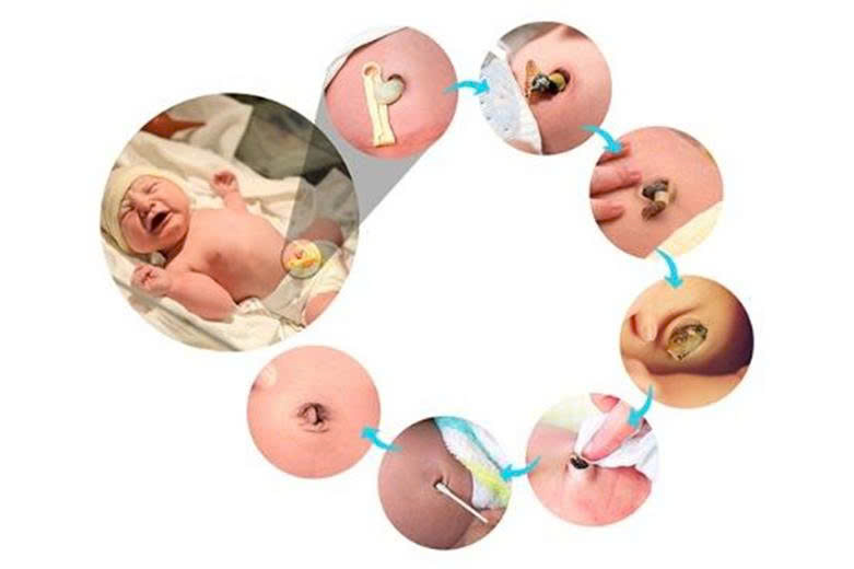 CHĂM SÓC RỐN CHO TRẺ SƠ SINH