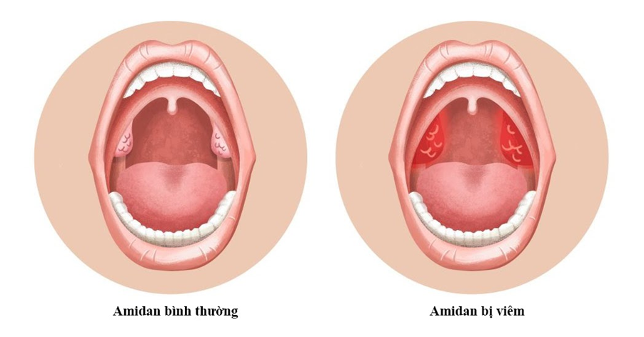 VIÊM AMIDAN Ở TRẺ EM: NGUYÊN NHÂN, DẤU HIỆU VÀ BIỆN PHÁP ĐIỀU TRỊ